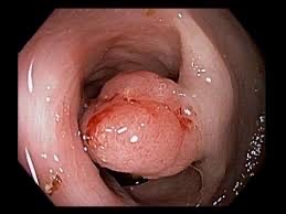 Colonoscopy example image showing a colorectal tumor-like lesion