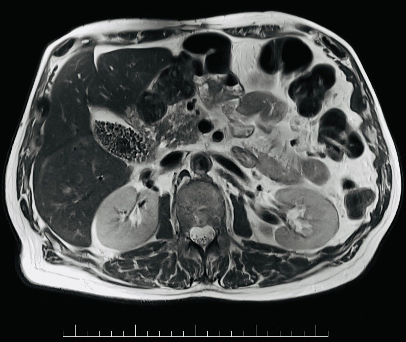 MRI abdomen/pelvis example used to illustrate staging imaging